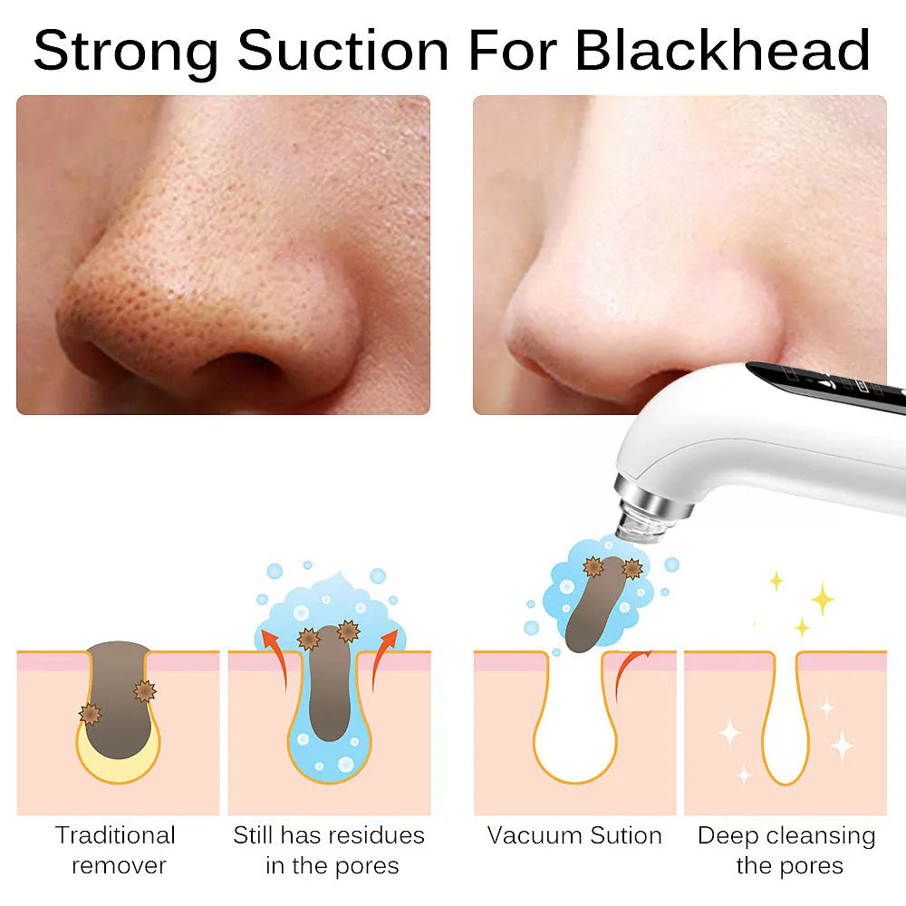 Rechargeable Blackhead Remover