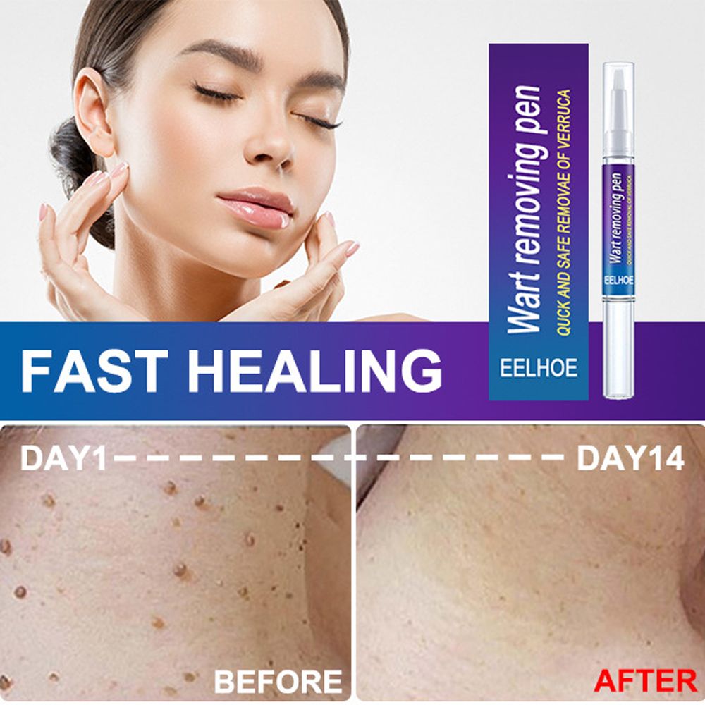 Removal Of Warts Liquid- Black Dots Beauty Health Skin Care