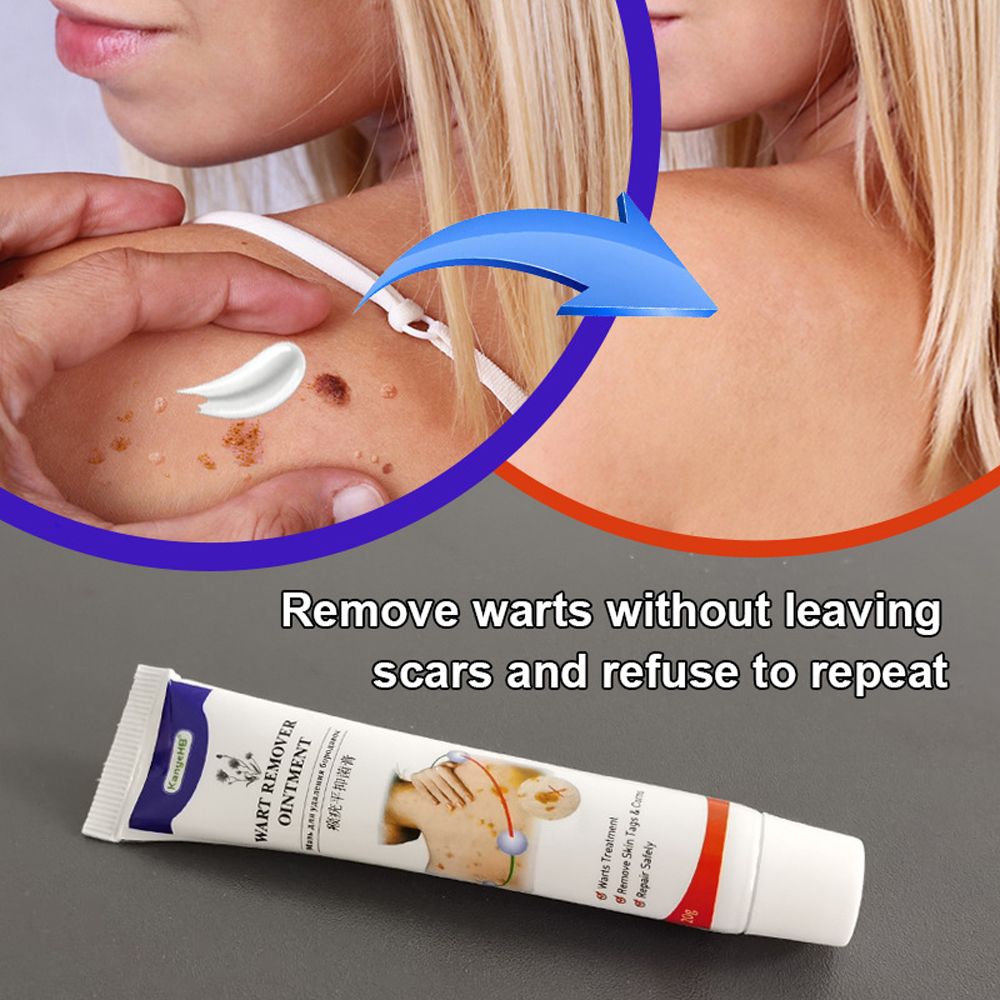 Removal Of Warts Liquid- Black Dots Beauty Health Skin Care